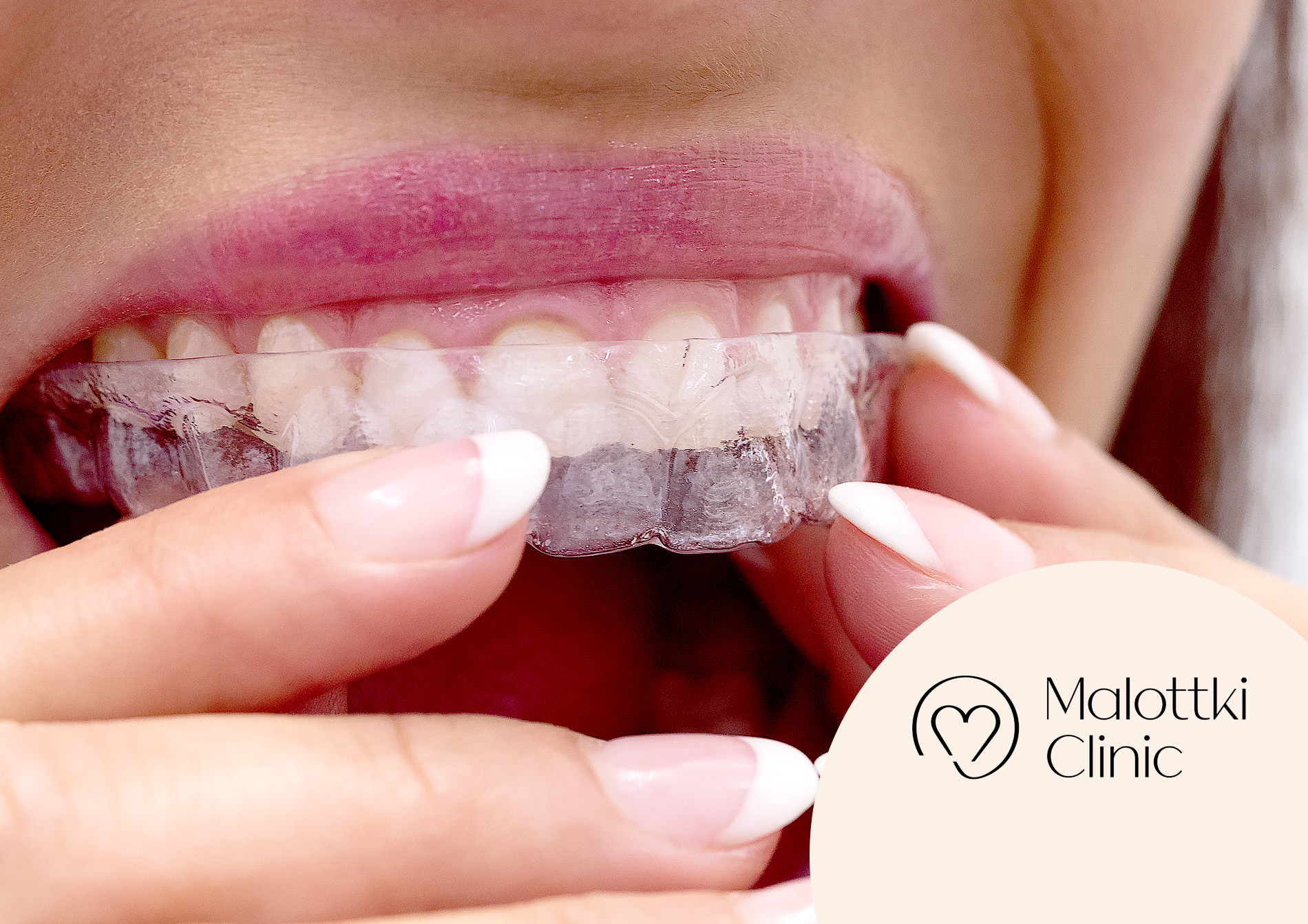 niewidoczny aparat invisalign opole