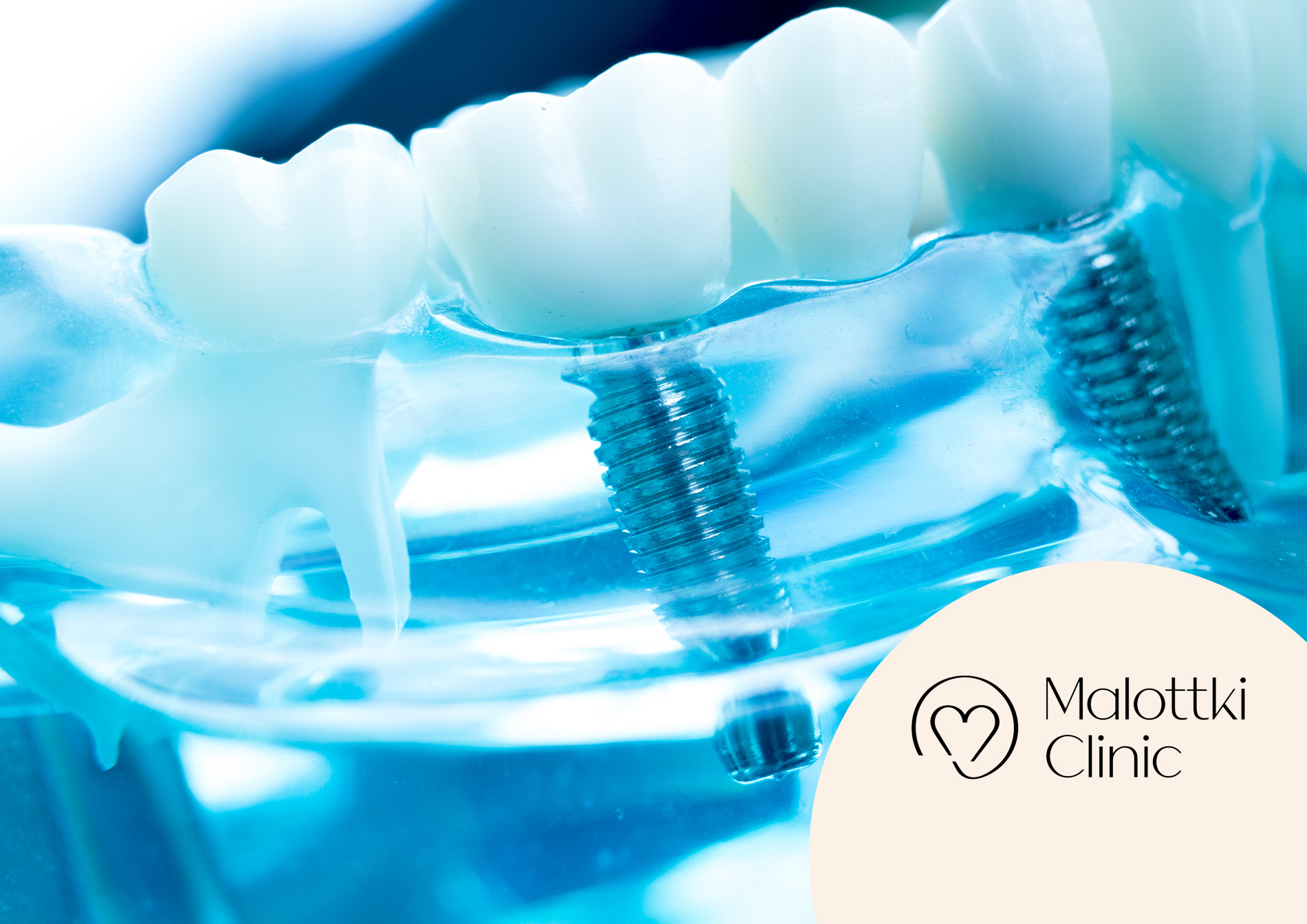 odbudowa kości pod implant