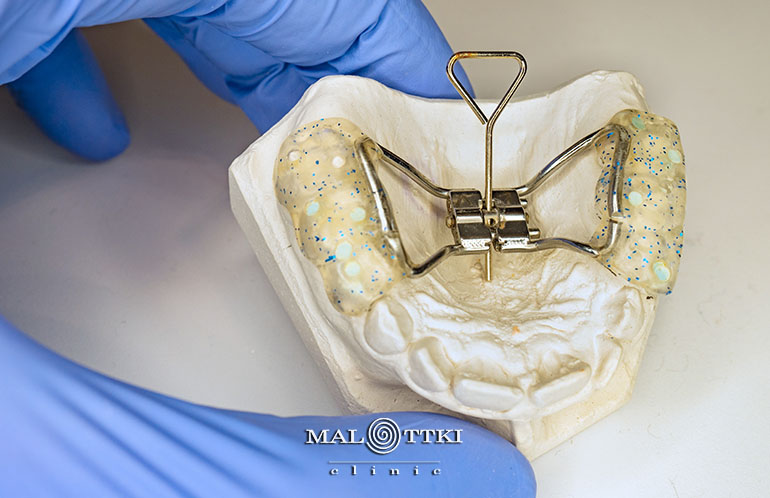 Aparat na zęby ze śrubą hyrax