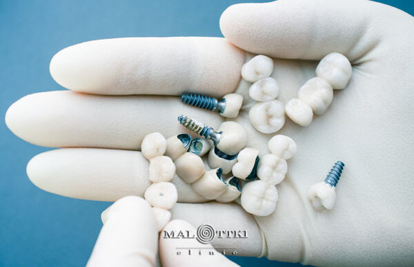 Implanty w jeden dzień w Opolu