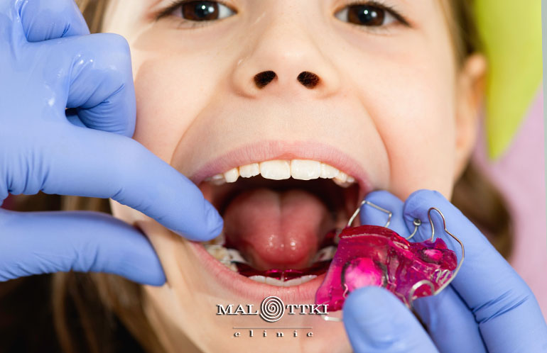 Płytka retencyjna Hawley'a