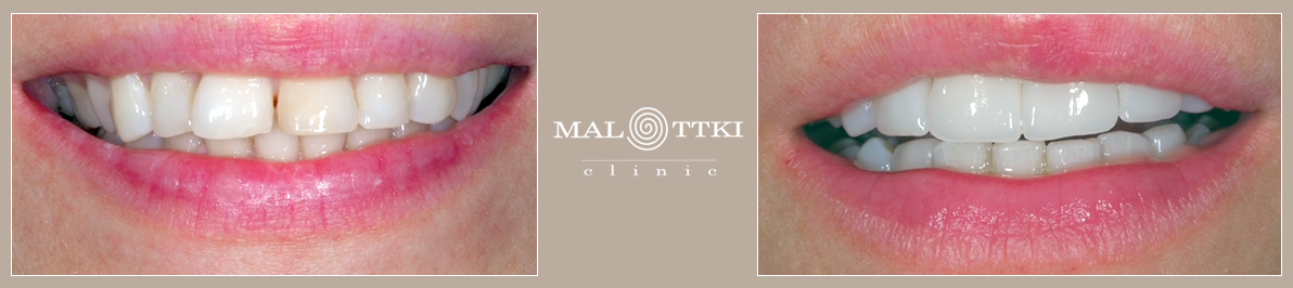 Porcelanowe licówki, wybielenie zębów Prevdent