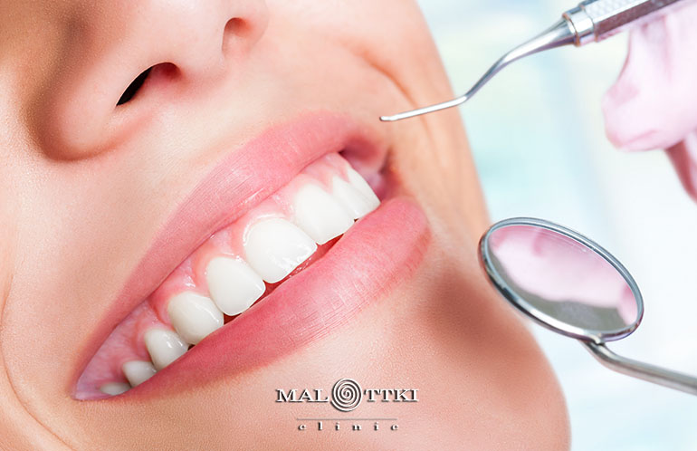 Usuwanie kamienia nazębnego w Opolu