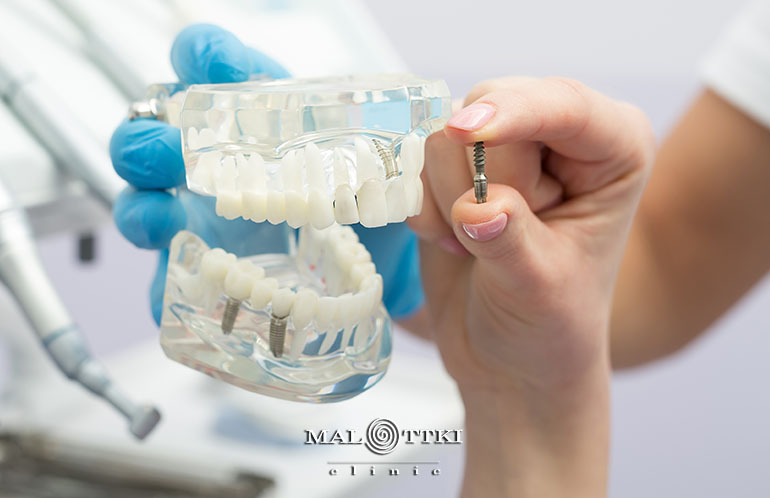 Wszystko co warto wiedzieć o implantach